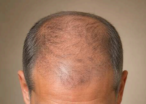 Advanced Hair Thinning