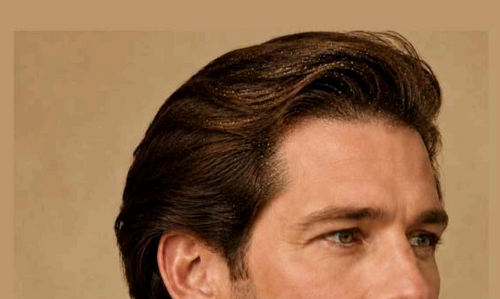 Dandruff-Prone Scalp