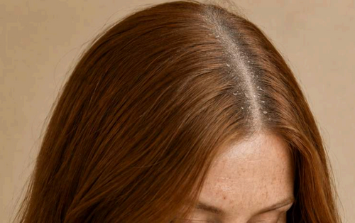 Dry / Flaky Scalp
