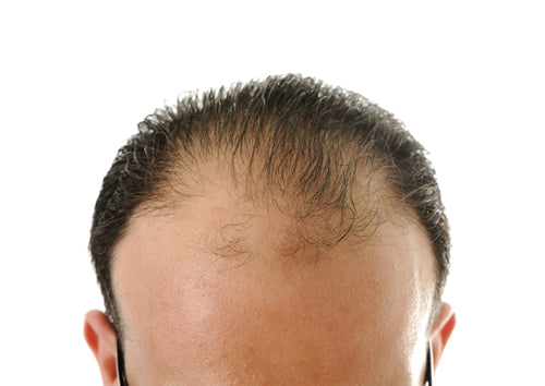 Heavy Hair Loss