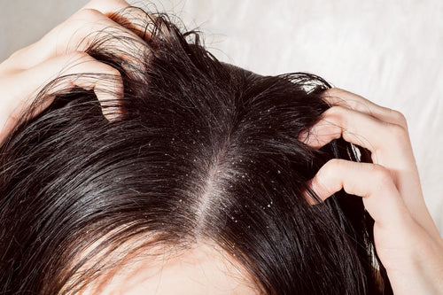 Oily Scalp with Dandruff
